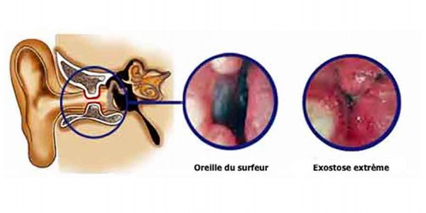  El oído del surfista o exostosis